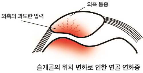 [크기변환][크기변환]김수원 병원장-슬개골연골연화증1.jpg